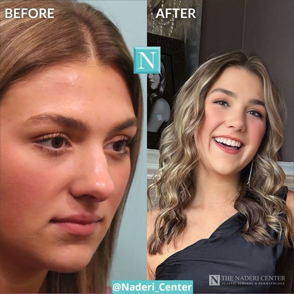 Rhinoplasty before and after photos shared by a patient of The Naderi Center