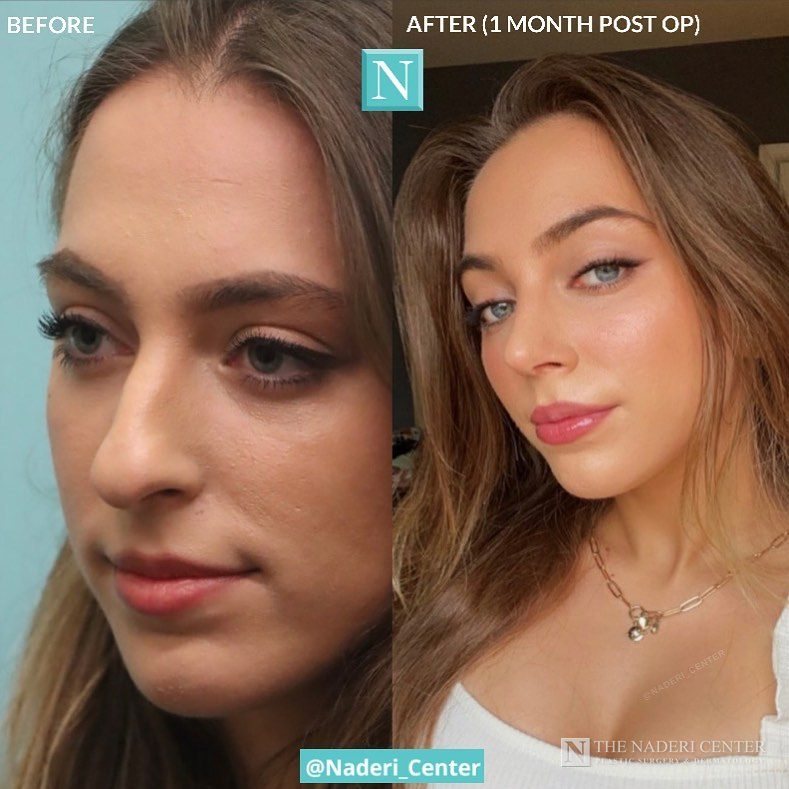 Rhinoplasty before and after photos shared by a patient of The Naderi Center