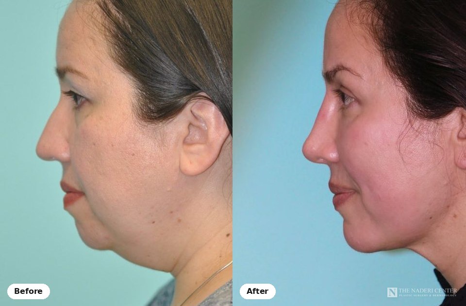 Rhinoplasty, chin implant and neck liposuction before and after photos shared by a patient of The Naderi Center