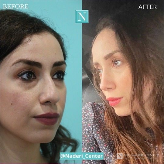 Rhinoplasty before and after photos shared by a patient of The Naderi Center