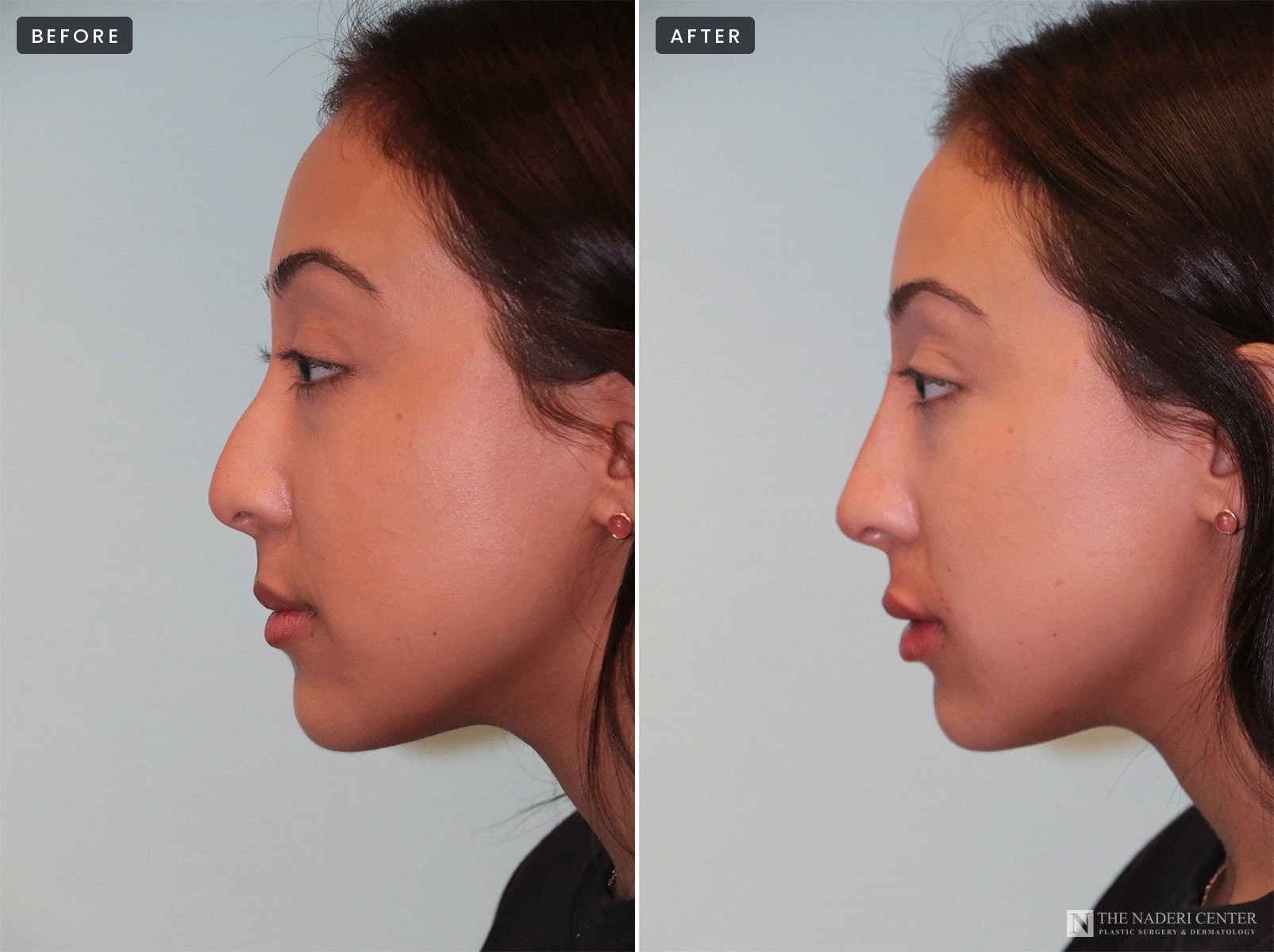 Before and after non-surgical (liquid) rhinoplasty with filler, side view, The Naderi Center