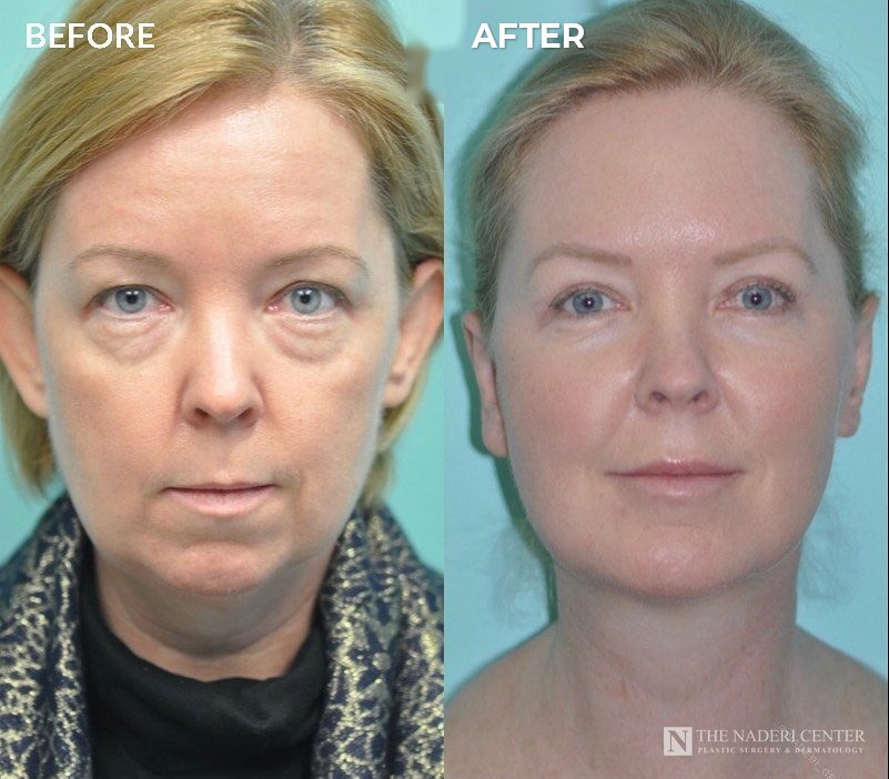 Otoplasty, eyelid surgery and chin augmentation before and after, real patient at The Naderi Center in Reston, VA and Chevy Chase, MD