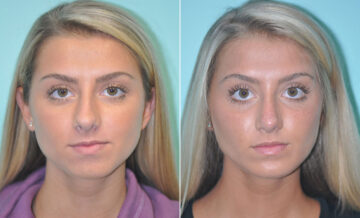 Chin & Facial Implant before and after at The Naderi Center, Reston, VA and Chevy Chase, MD, Patient 11614