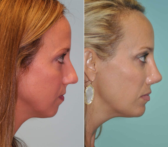 Rhinoplasty before and after at The Naderi Center, Reston, VA and Chevy Chase, MD, Patient 11875