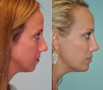 Chin & Facial Implant before and after at The Naderi Center, Reston, VA and Chevy Chase, MD, Patient 11901