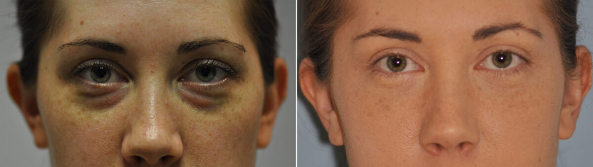 Blepharoplasty before and after at The Naderi Center, Reston, VA and Chevy Chase, MD, Patient 11983