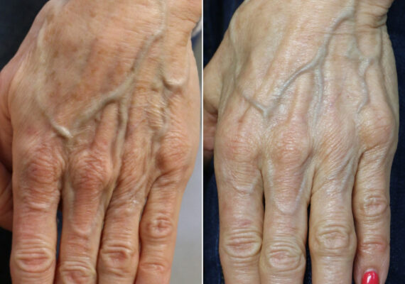 Light Therapy before and after, Patient 12225