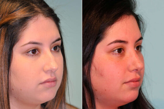 Rhinoplasty before and after at The Naderi Center, Reston, VA and Chevy Chase, MD, Patient 12701