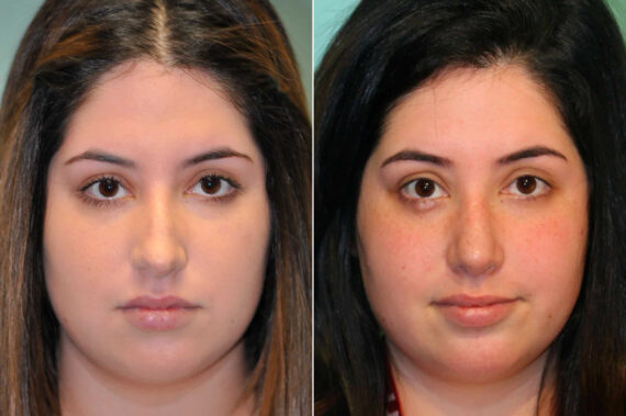 Rhinoplasty before and after at The Naderi Center, Reston, VA and Chevy Chase, MD, Patient 12701