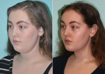 Neck Liposuction before and after at The Naderi Center, Reston, VA and Chevy Chase, MD, Patient 12726
