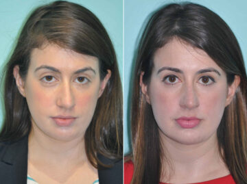 Neck Liposuction before and after at The Naderi Center, Reston, VA and Chevy Chase, MD, Patient 12809