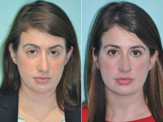 Neck Liposuction before and after at The Naderi Center, Reston, VA and Chevy Chase, MD, Patient 12809
