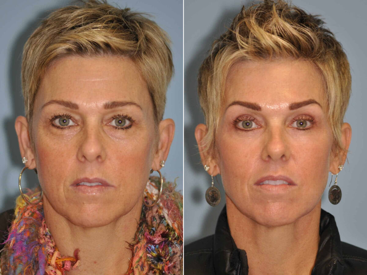 Light Therapy before and after, Patient 13012