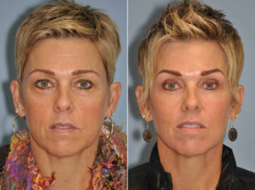 Light Therapy before and after, Patient 13012
