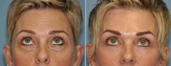 Blepharoplasty before and after at The Naderi Center, Reston, VA and Chevy Chase, MD, Patient 13041