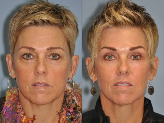 Blepharoplasty before and after at The Naderi Center, Reston, VA and Chevy Chase, MD, Patient 13041