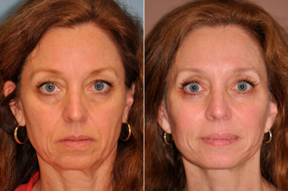 Facelift before and after at The Naderi Center, Reston, VA and Chevy Chase, MD, Patient 13287