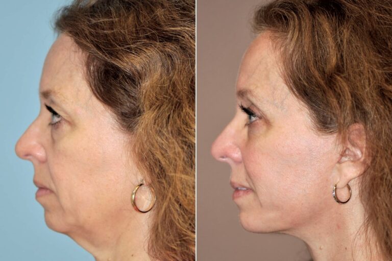 Before and after facelift, side profile: jowls and facial laxity