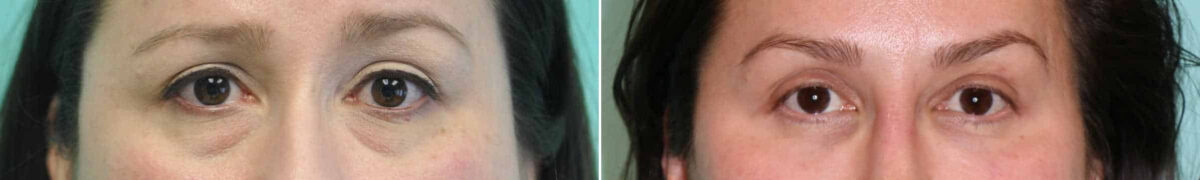 Blepharoplasty before and after at The Naderi Center, Reston, VA and Chevy Chase, MD, Patient 13582