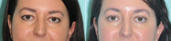 Blepharoplasty before and after at The Naderi Center, Reston, VA and Chevy Chase, MD, Patient 14206