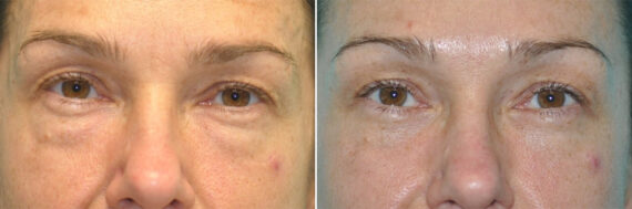 Blepharoplasty before and after at The Naderi Center, Reston, VA and Chevy Chase, MD, Patient 14268