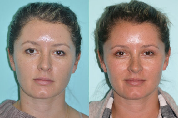 Blepharoplasty before and after at The Naderi Center, Reston, VA and Chevy Chase, MD, Patient 14278