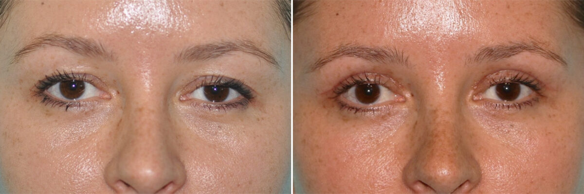 Blepharoplasty before and after at The Naderi Center, Reston, VA and Chevy Chase, MD, Patient 14278