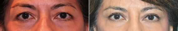 Blepharoplasty before and after at The Naderi Center, Reston, VA and Chevy Chase, MD, Patient 14448