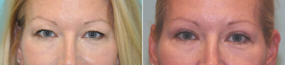 Blepharoplasty before and after at The Naderi Center, Reston, VA and Chevy Chase, MD, Patient 14484