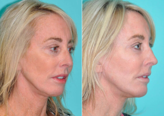 Fat Transfer before and after at The Naderi Center, Reston, VA and Chevy Chase, MD, Patient 14568