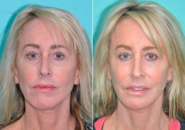 Fat Transfer before and after at The Naderi Center, Reston, VA and Chevy Chase, MD, Patient 14568