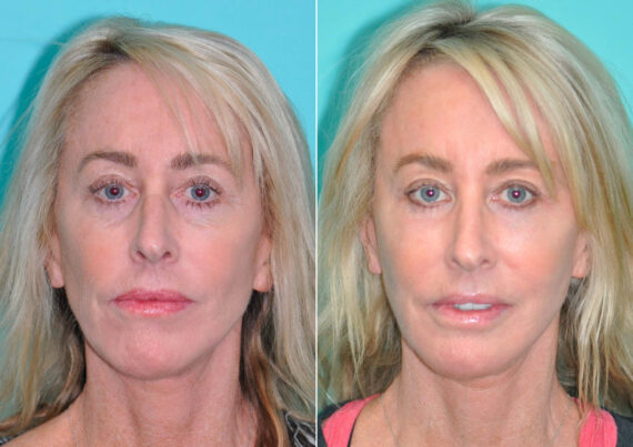 Fat Transfer before and after at The Naderi Center, Reston, VA and Chevy Chase, MD, Patient 14568