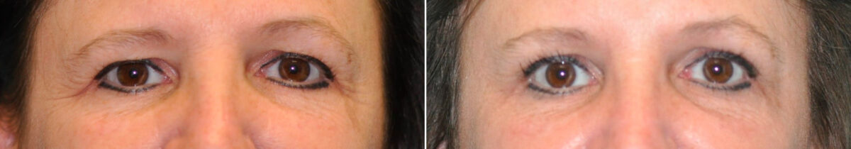 Blepharoplasty before and after at The Naderi Center, Reston, VA and Chevy Chase, MD, Patient 14589