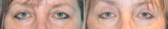 Blepharoplasty before and after at The Naderi Center, Reston, VA and Chevy Chase, MD, Patient 14644
