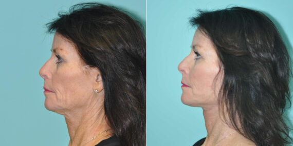 Fat Transfer before and after at The Naderi Center, Reston, VA and Chevy Chase, MD, Patient 14683