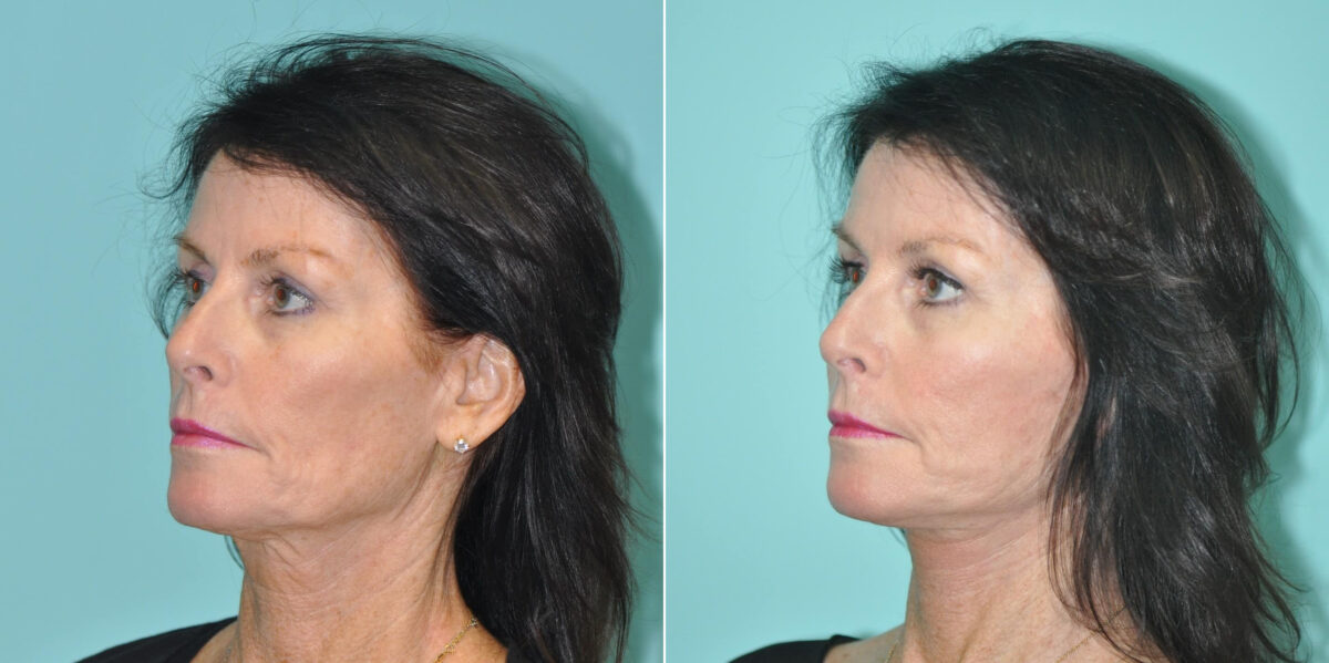 Fat Transfer before and after at The Naderi Center, Reston, VA and Chevy Chase, MD, Patient 14683