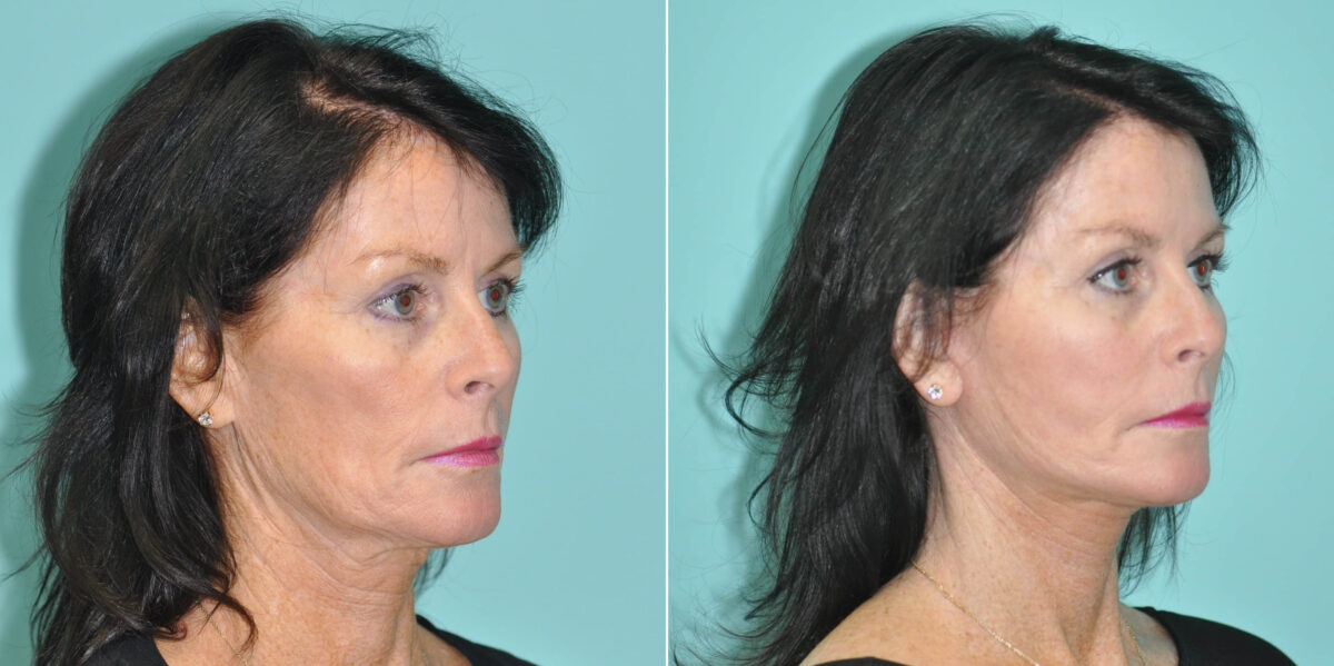 Fat Transfer before and after at The Naderi Center, Reston, VA and Chevy Chase, MD, Patient 14683
