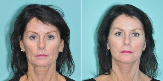 Fat Transfer before and after at The Naderi Center, Reston, VA and Chevy Chase, MD, Patient 14683