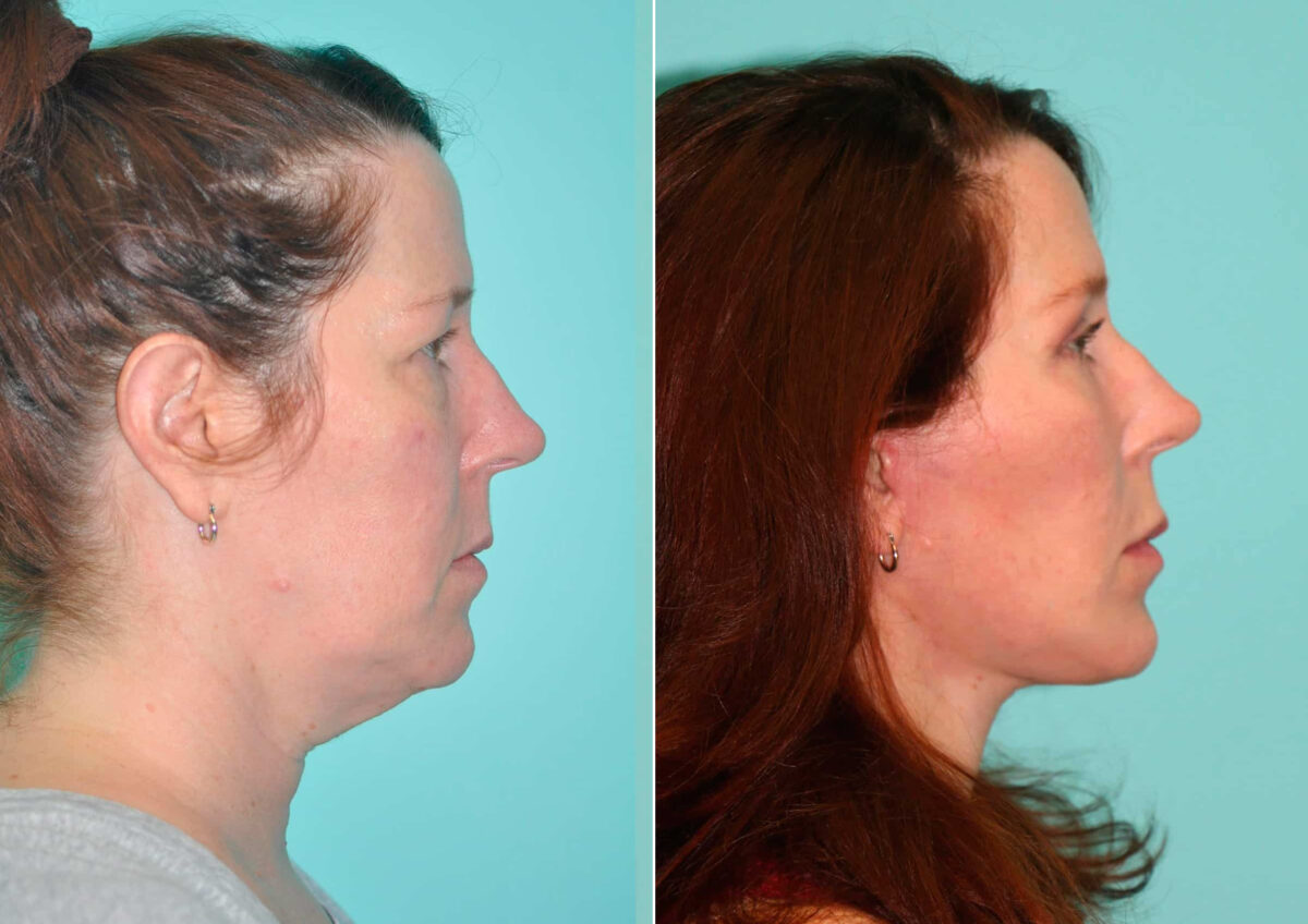 Facelift before and after at The Naderi Center, Reston, VA and Chevy Chase, MD, Patient 14855