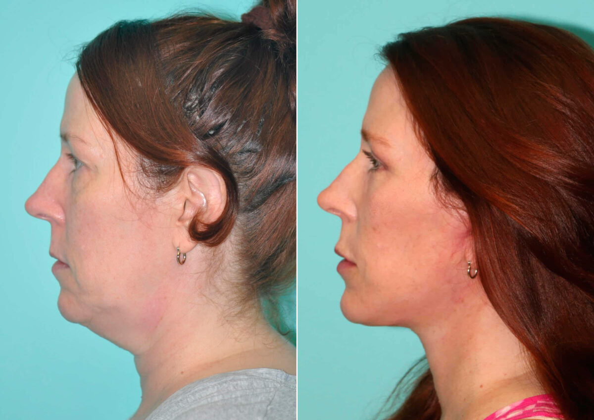 Facelift before and after at The Naderi Center, Reston, VA and Chevy Chase, MD, Patient 14855