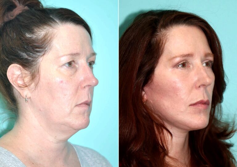 Before and after facelift: a full facial rejuvenation
