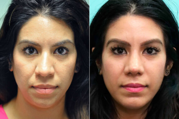 Chin & Facial Implant before and after at The Naderi Center, Reston, VA and Chevy Chase, MD, Patient 17613