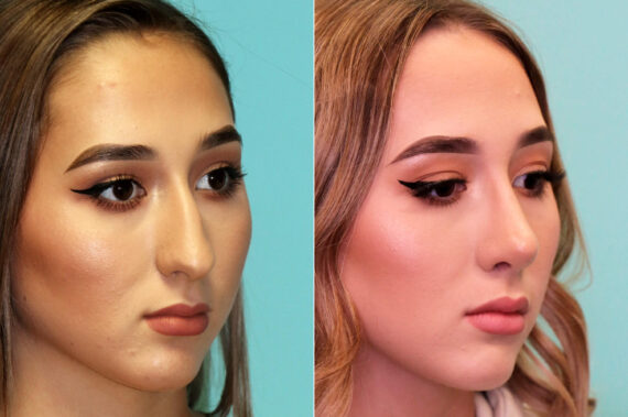 Rhinoplasty before and after at The Naderi Center, Reston, VA and Chevy Chase, MD, Patient 17661