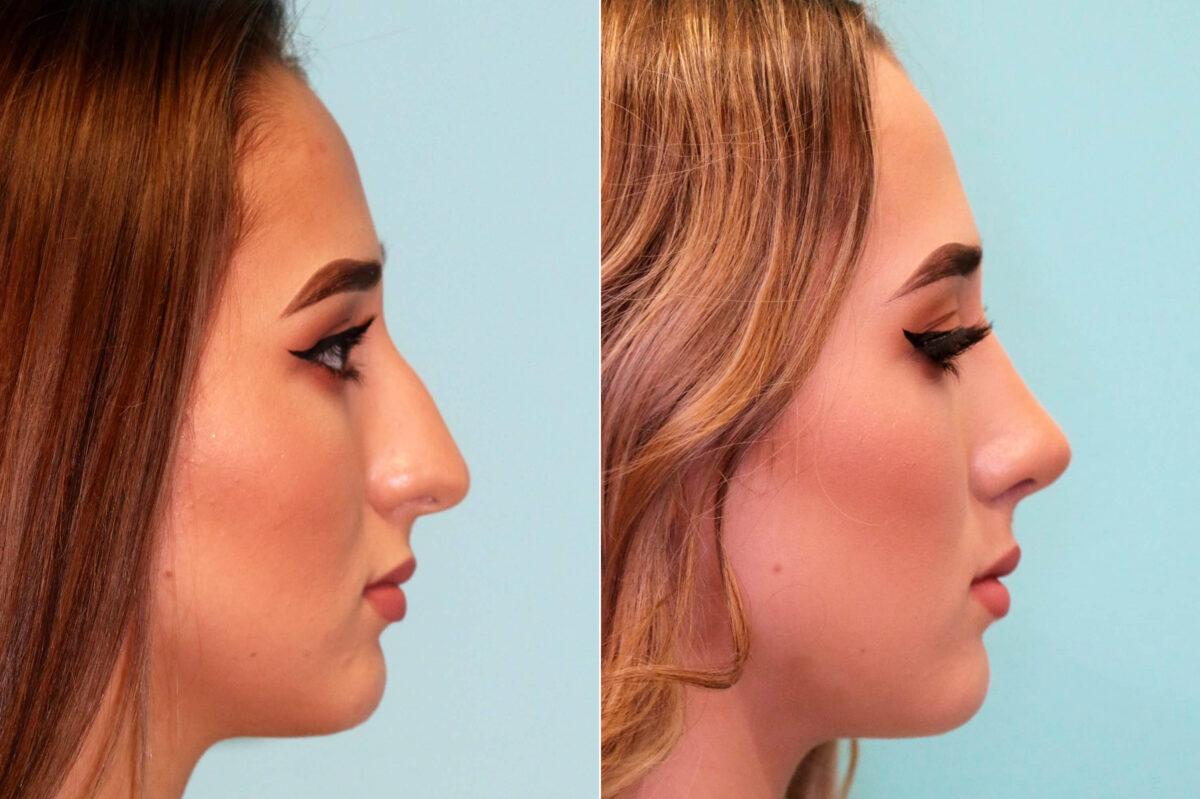 Rhinoplasty before and after at The Naderi Center, Reston, VA and Chevy Chase, MD, Patient 17661