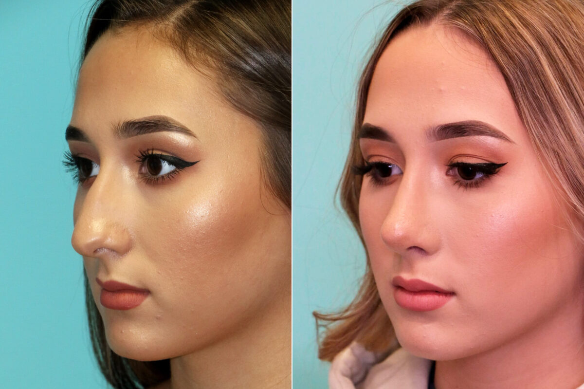 Rhinoplasty before and after at The Naderi Center, Reston, VA and Chevy Chase, MD, Patient 17661