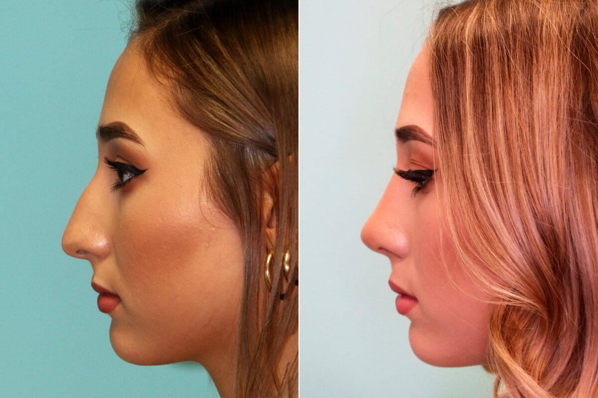 Rhinoplasty before and after at The Naderi Center, Reston, VA and Chevy Chase, MD, Patient 17661