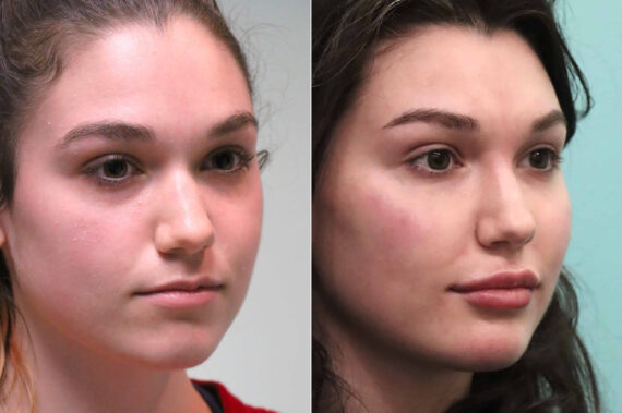 Cheeks / Midface Injections before and after, Patient 18935
