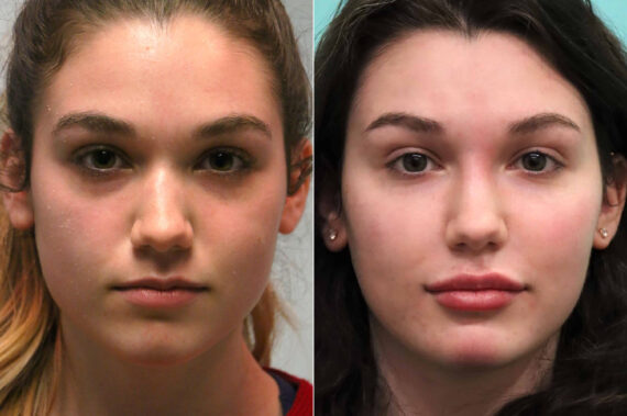 Cheeks / Midface Injections before and after, Patient 18935