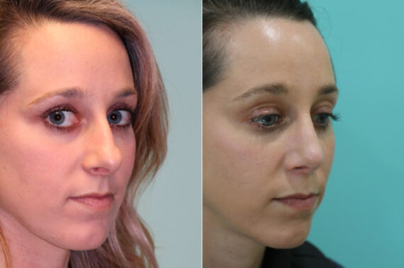 Rhinoplasty before and after at The Naderi Center, Reston, VA and Chevy Chase, MD, Patient 19032