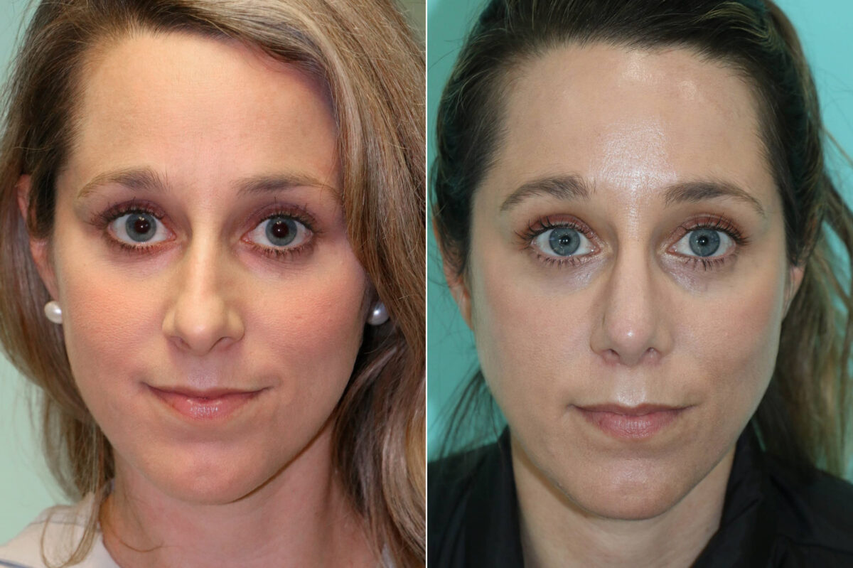Rhinoplasty before and after at The Naderi Center, Reston, VA and Chevy Chase, MD, Patient 19032